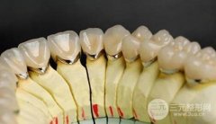 烤瓷牙的种类及价钱|镍铬|钴铬|纯钛|合金烤瓷牙哪种好？