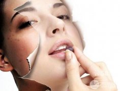 像素激光美容PK光子嫩肤?谁好?