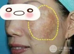 蝴蝶斑怎么去？激光和光子去黄褐斑的果哪个更胜一筹？