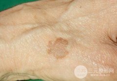 手上长老年斑怎么去掉？激光缓解老年斑果杠杠的！