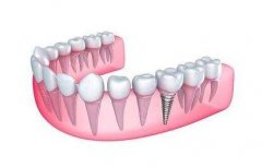 种植牙的价格 种植牙好不好