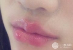 北京丰唇需要多少钱?丰唇用什么材料好呢? 北京丰唇需要多少钱?丰唇用什么材料好呢?