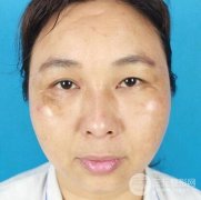 黄褐斑的形成原因是什么？激光缓解案例果图片真实分享~