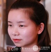 垫下巴什么材料好？杭州时光玻尿酸注射图片案例分享~