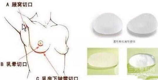 隆胸材料
