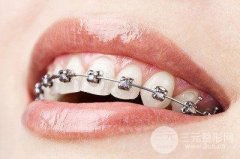 箍牙的危害有哪些？会改变脸型吗？