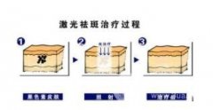 手上为什么会长老年斑 激光去老年斑怎么样