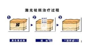 老年斑