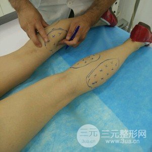 注射瘦腿会反弹吗 真人案例前后对比图为你解答