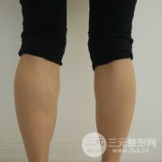注射瘦腿会反弹吗 真人案例前后对比图为你解答