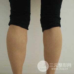 注射瘦腿会反弹吗 真人案例前后对比图为你解答