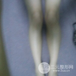 注射瘦腿会反弹吗 真人案例前后对比图为你解答
