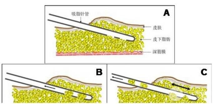 注射瘦腿成好吗和吸脂瘦腿有什么区别哪种方法喜欢