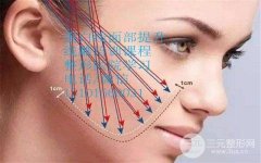 北京做大v线提升面部多少钱 恢复期有多久？