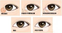 北京双眼皮开眼角需要多少钱？