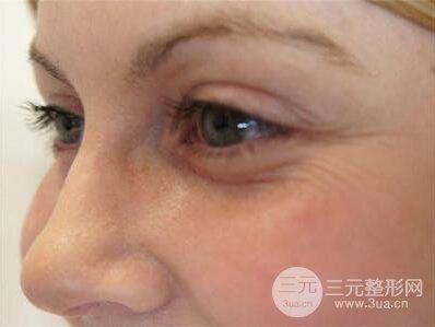 去除鱼尾纹的方法？去除鱼尾纹的方法有哪些？