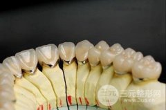 钴铬烤瓷牙好不好 优缺点一览