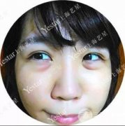 超声波去眼袋价格是多少钱？艺星案例果图片分享~