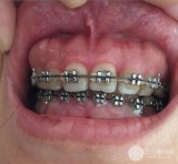 骨性龅牙要怎么矫正？