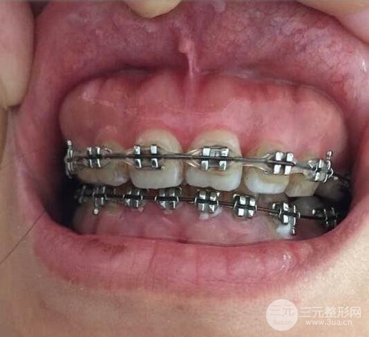骨性龅牙要怎么矫正?