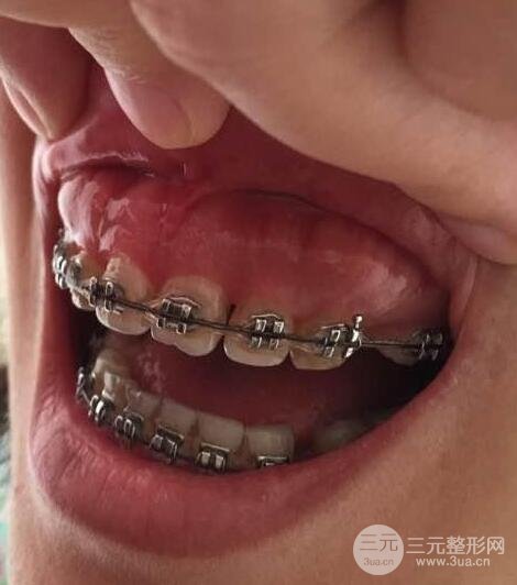 骨性龅牙要怎么矫正?