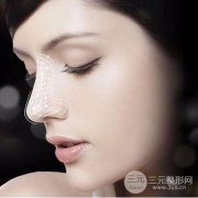 隆鼻什么材料好?隆鼻有哪些材料? 隆鼻什么材料好?隆鼻有哪些材料?