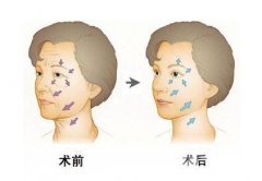 锯齿.线埋埋提升除皱价格多少 锯齿.线埋埋提升除皱价格多少