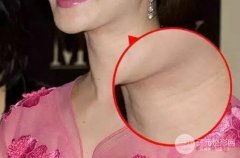 去除颈纹喜欢的方法?嗨.体去颈纹真实案例恢复过程分享