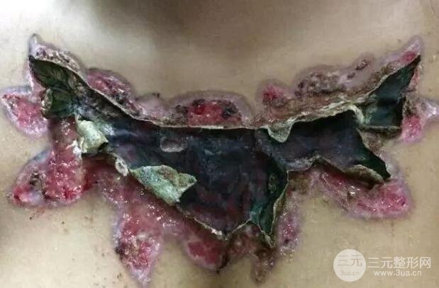 洗纹身疼么药水洗纹身的危害真实例子展示