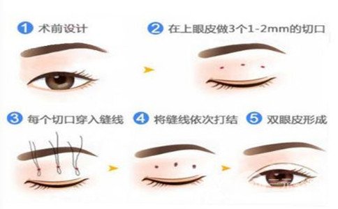 三点定位双眼皮手术优势有哪些、三点定位双眼皮过程图