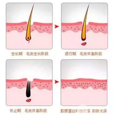 激光脱唇毛