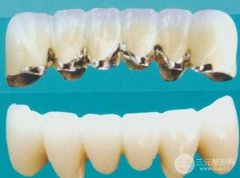 一个烤瓷牙多少钱?烤瓷牙价格多少?