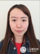 打玻尿酸后注意什么?真人注射过程果图片 打玻尿酸后注意什么?真人注射过程果图片