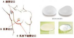 什么是双平面丰胸?