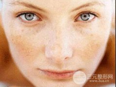 脸上蝴蝶斑怎么去 形成原因是什么