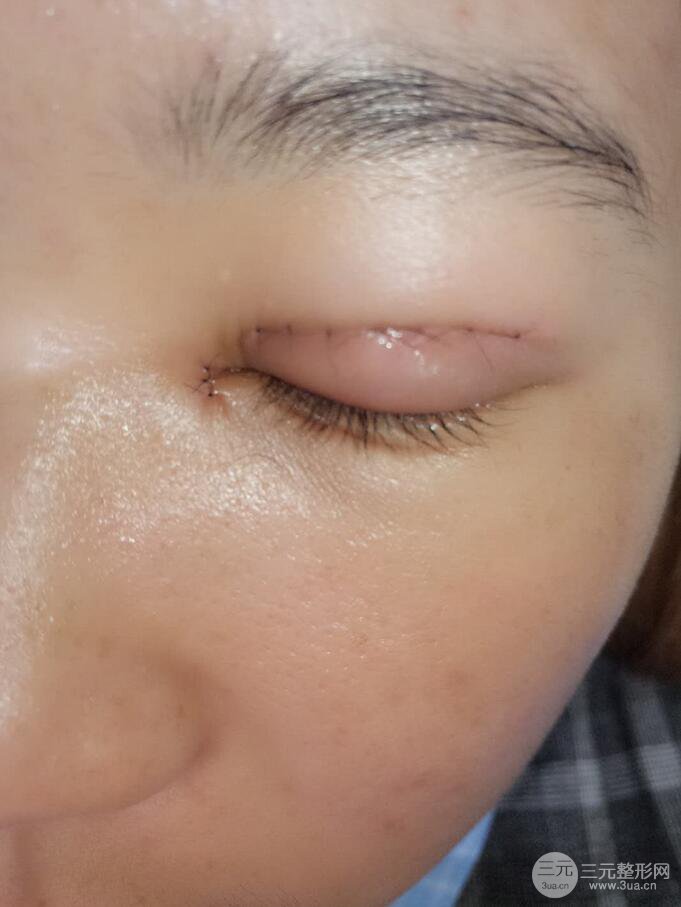 昆明丽都李平珍切开双眼皮案例