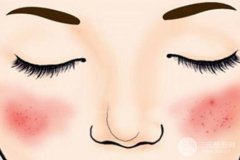 缓解红血丝的费用|缓解红血丝多少钱? 缓解红血丝的费用|缓解红血丝多少钱?