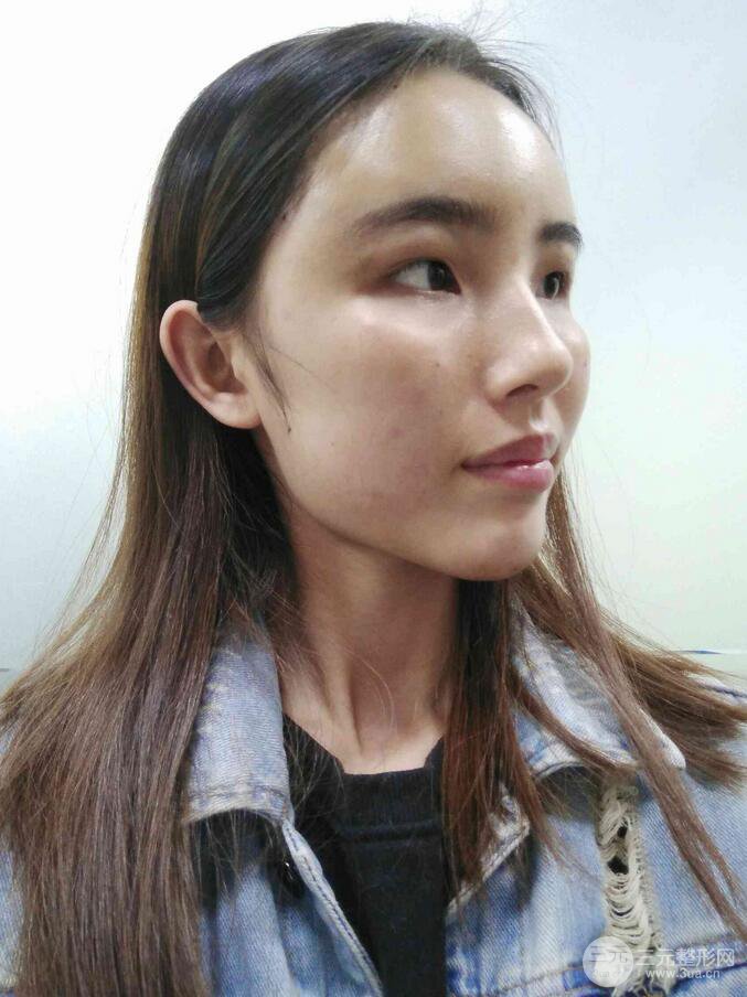 额头填充对比照片自体脂肪填充全脸案例恢复过程分享