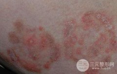 花斑癣有什么缓解方法？会传染和复发吗？