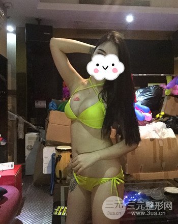 襄阳自体脂肪隆胸真人案例,恢复过程及果分享