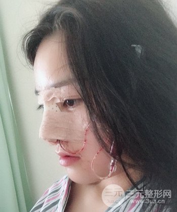 达拉斯综合隆鼻后对比照片，颜值提高不是梦
