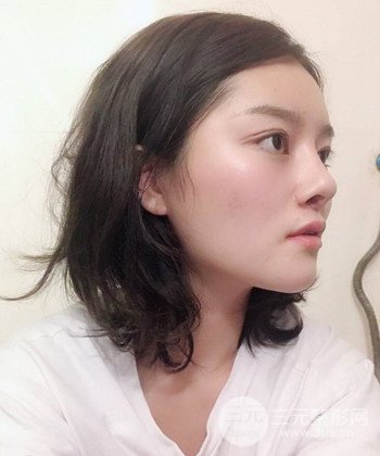 达拉斯综合隆鼻后对比照片，颜值提高不是梦