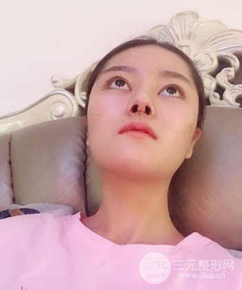 达拉斯综合隆鼻后对比照片，颜值提高不是梦