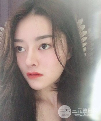 达拉斯综合隆鼻后对比照片，颜值提高不是梦
