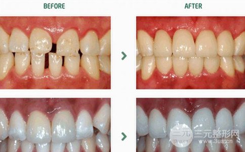 镍铬烤瓷牙可以用吗、镍铬烤瓷牙多少钱