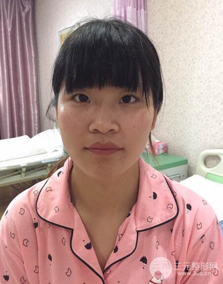 隆鼻鼻翼缩小全过程和术后照片分享，随意揉捏很OK