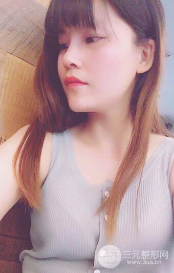 隆鼻鼻翼缩小全过程和术后照片分享，随意揉捏很OK