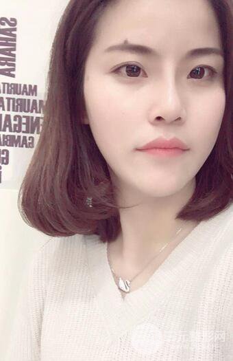 隆鼻鼻翼缩小全过程和术后照片分享，随意揉捏很OK