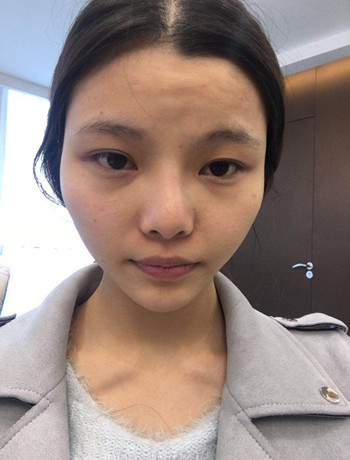 全脸自体脂肪填充+隆鼻整形果永.久保持、丑小鸭变天鹅不是梦