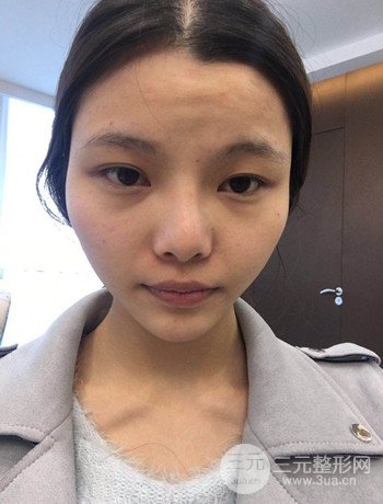 全脸自体脂肪填充+隆鼻整形果永.久保持、丑小鸭变天鹅不是梦